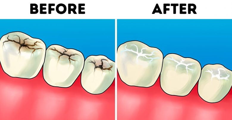 Шүдний хорхойг эмчгүйгээр эмчлэх боломжтой. Үр дүн нь гайхалтай!