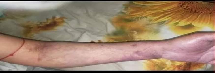 Хар тамхи хэрэглэсний улмаас өсвөр насны хүүхэд нас барсан таван тохиолдол бүртгэгдээд байна