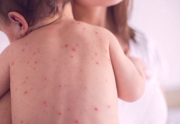 Улаанбурхан: Сүүлийн 24 цагт нийт 23 шинэ тохиолдол илэрчээ