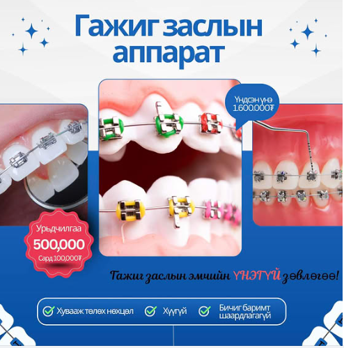 Танд гажиг заслын аппарат хэрэгтэй байна уу?