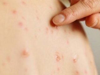 ХӨСҮТ: Улаанбурхан өвчний 10 шинэ тохиолдол бүртгэгдлээ