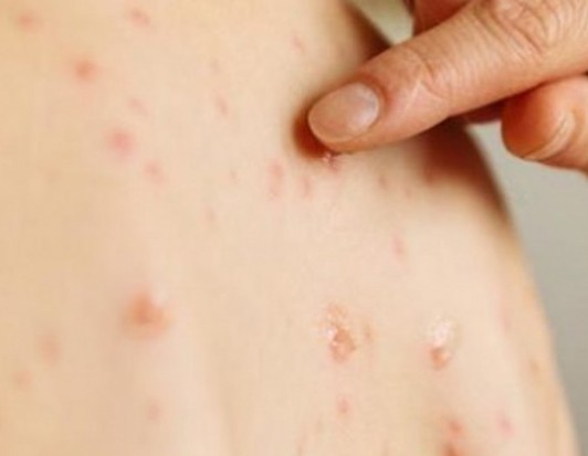 ХӨСҮТ: Улаанбурхан өвчний 10 шинэ тохиолдол бүртгэгдлээ