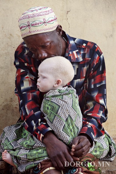 Альбиносчуудад Африк халгаатай